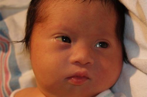 hội chứng down Trisomy 21