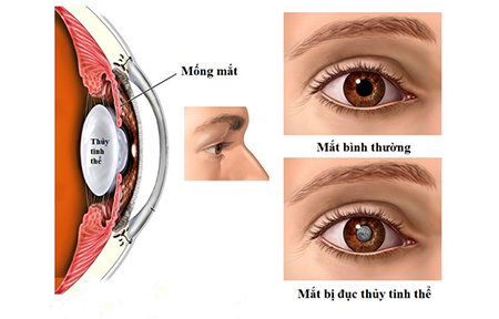 Chế độ dinh dưỡng cho người đục thủy tinh thể