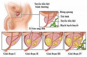 tầm soát ung thư tuyến tiền liệt