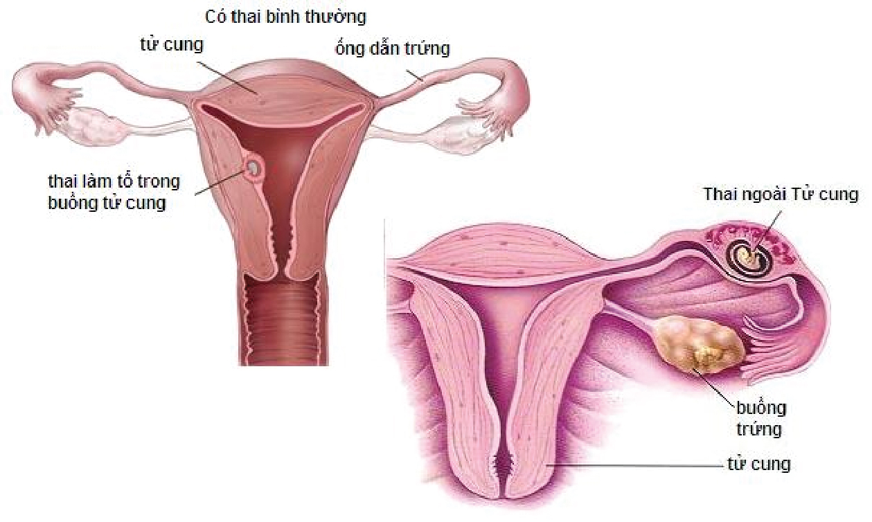 Mổ Chửa Ngoài Tử Cung Có Đặt Vòng Được Không? Hướng Dẫn Chi Tiết Và Lợi Ích