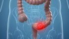 Colon Cancer, Artwork