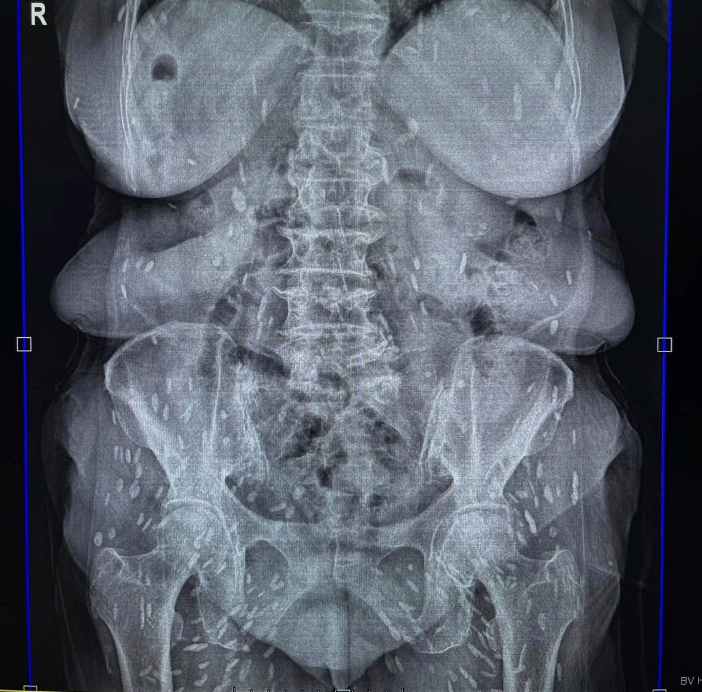 Một số hình ảnh bệnh nhân bị nhiễm Ấu trùng giun đũa chó Toxocara bệnh sán  chó