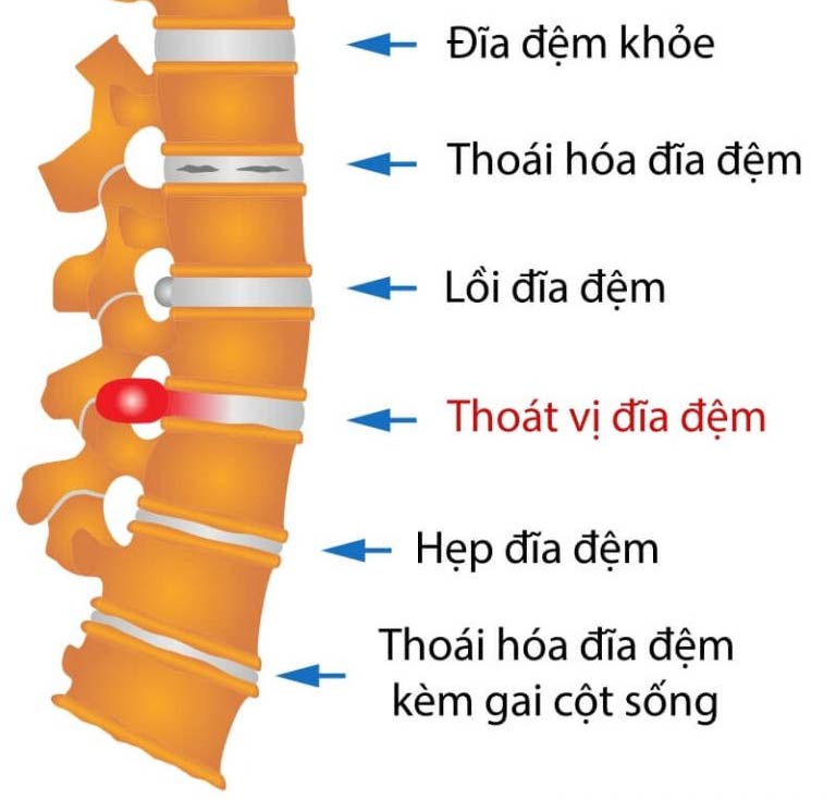 Thoát Vị đĩa đệm 2 01