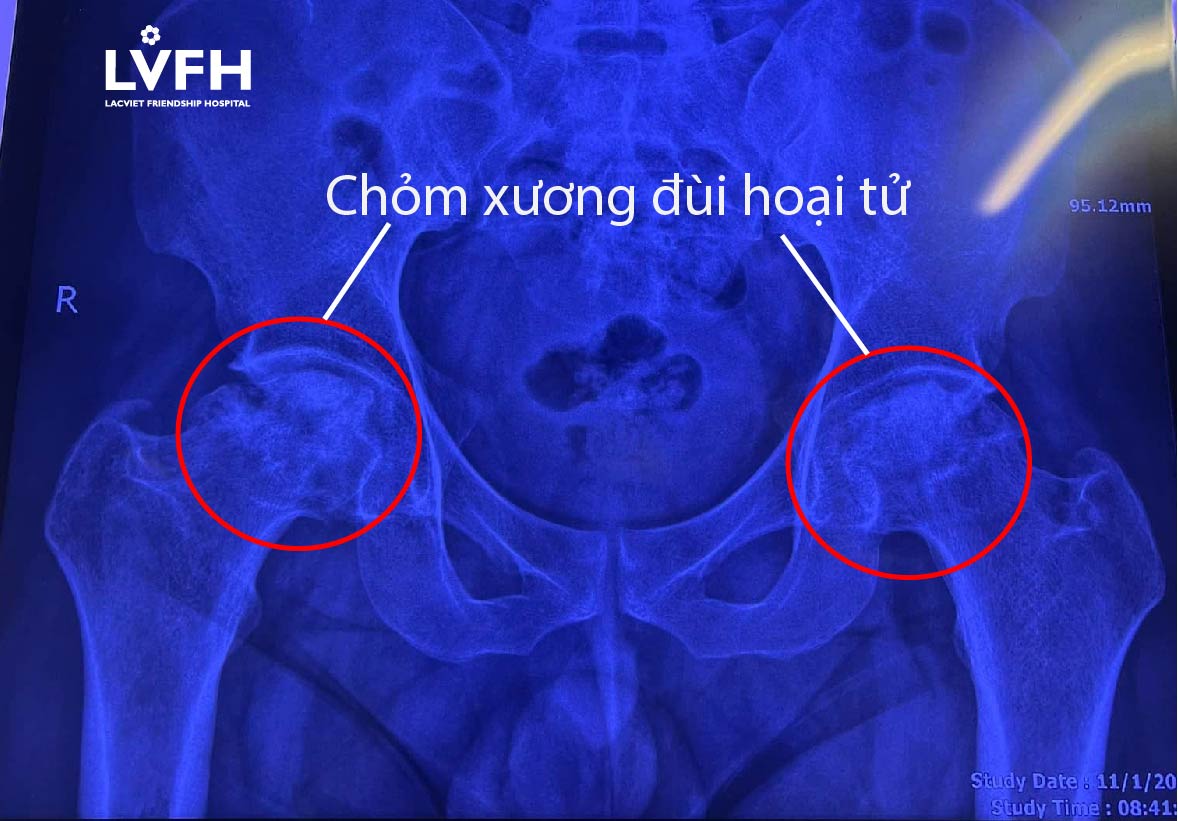 Hoại tử vô khuẩn có thể gây biến chứng nghiêm trọng không?
