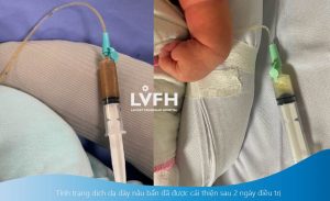 Viêm Ruột 01