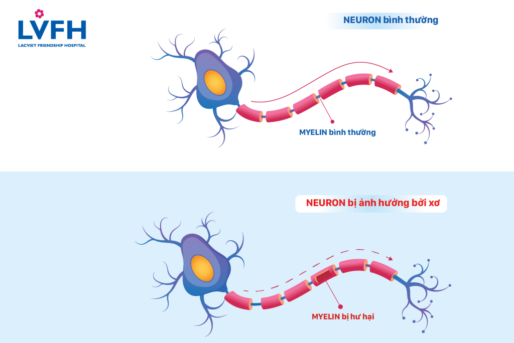 Myelin-binh-thuong-va-myelin-bi-hu-hai-trong-xo-cung-rai-rac-co-the-phat-hien-qua-chup-cong-huong-tu-3.0-Tesla