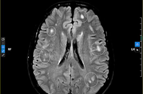 ChẤt TrẮng RẢi RÁc Phim ChỤp Mri