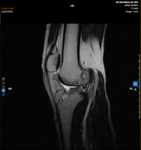 Hình ảnh Chụp Mri. Đứt Dây Chằng Chéo Lần 2