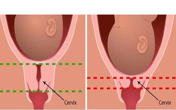 Tử Cung Ngắn: Nguyên Nhân, Triệu Chứng và Biện Pháp Điều Trị Hiệu Quả