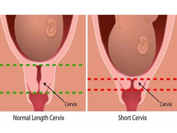 Cổ tử cung bình thường và cổ tử cung ngắn