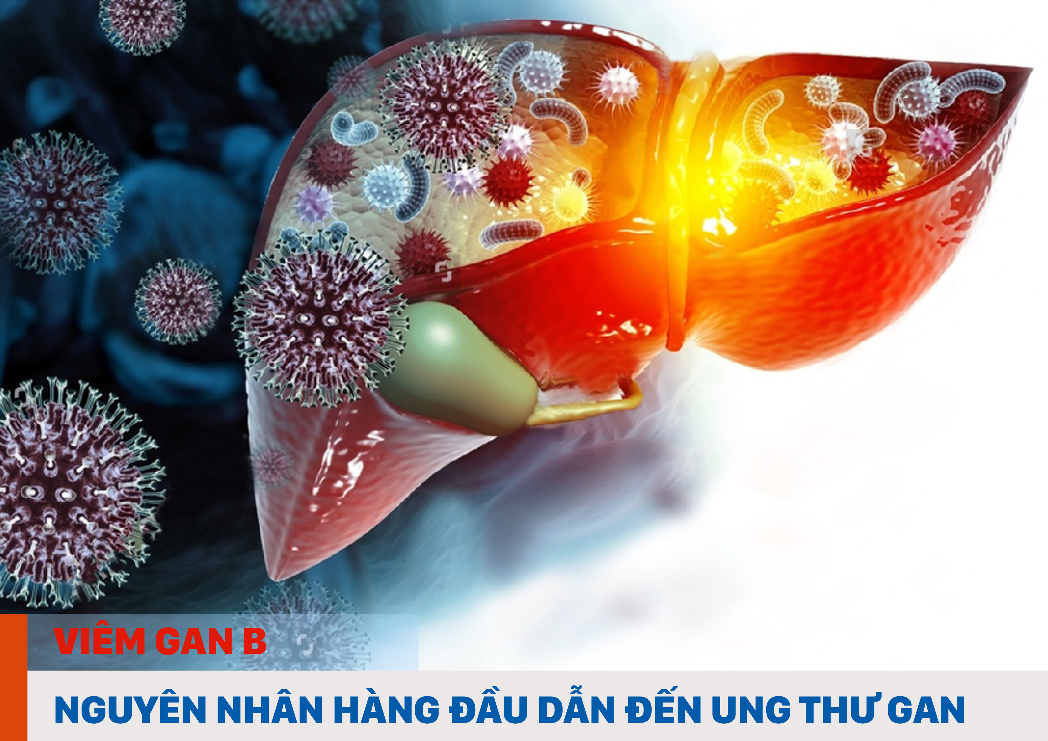 Viêm Gan B - Nguyên Nhân Hàng đầu Dẫn đến Ung Thư Gan