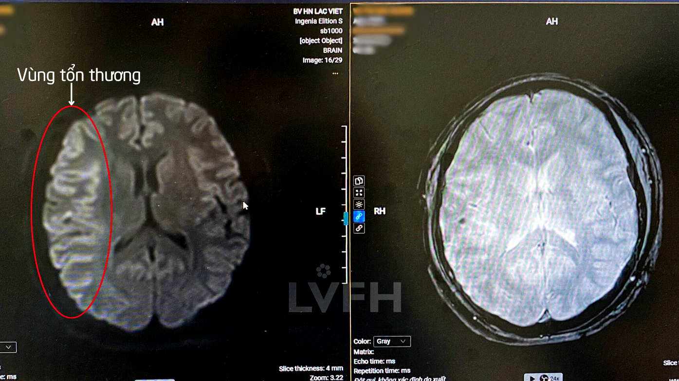 Hình ảnh cho thấy vùng tổn thương trên phim chụp Công hưởng từ MRI 3.0 của bệnh nhân