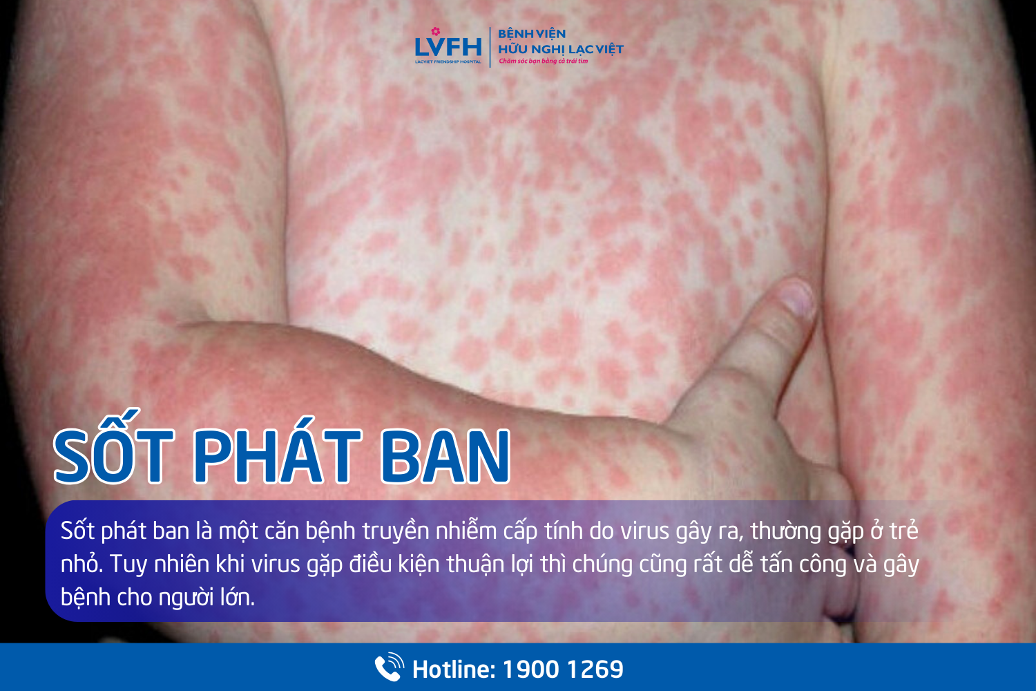 4. Phương Pháp Chẩn Đoán Sốt Phát Ban