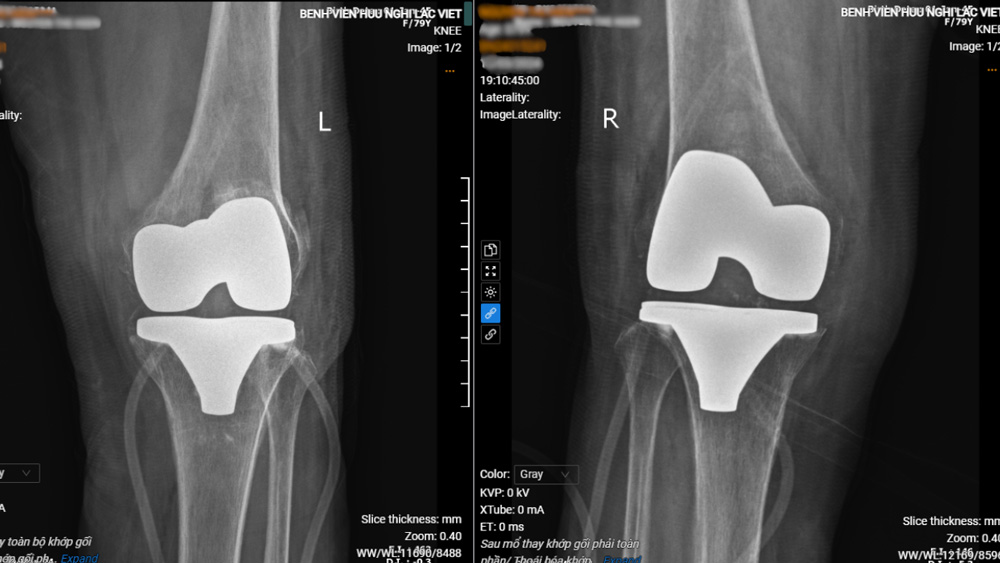 Hình ảnh khớp gối bệnh nhân sau phẫu thuật