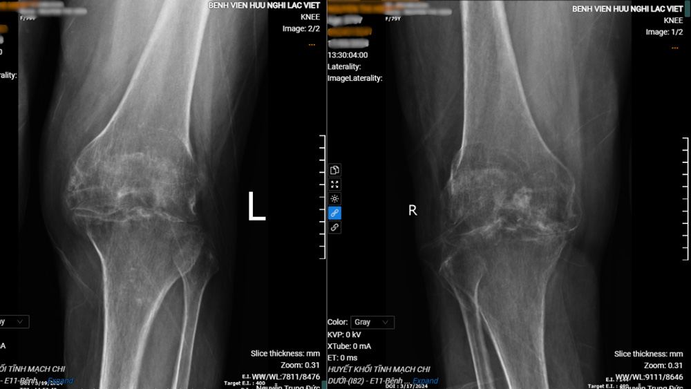 Hình ảnh khớp gối của bệnh nhân trước khi phẫu thuật