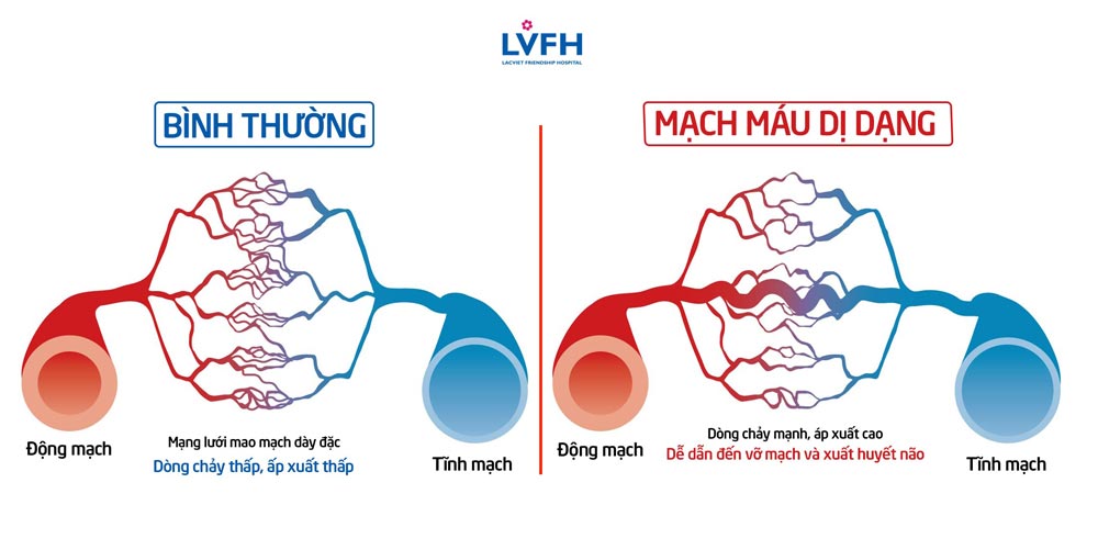 Dị dạng mạch máu khiến dòng chảy mạnh, áp xuất cao, dễ dẫn đến vỡ mạch, xuất huyết não.