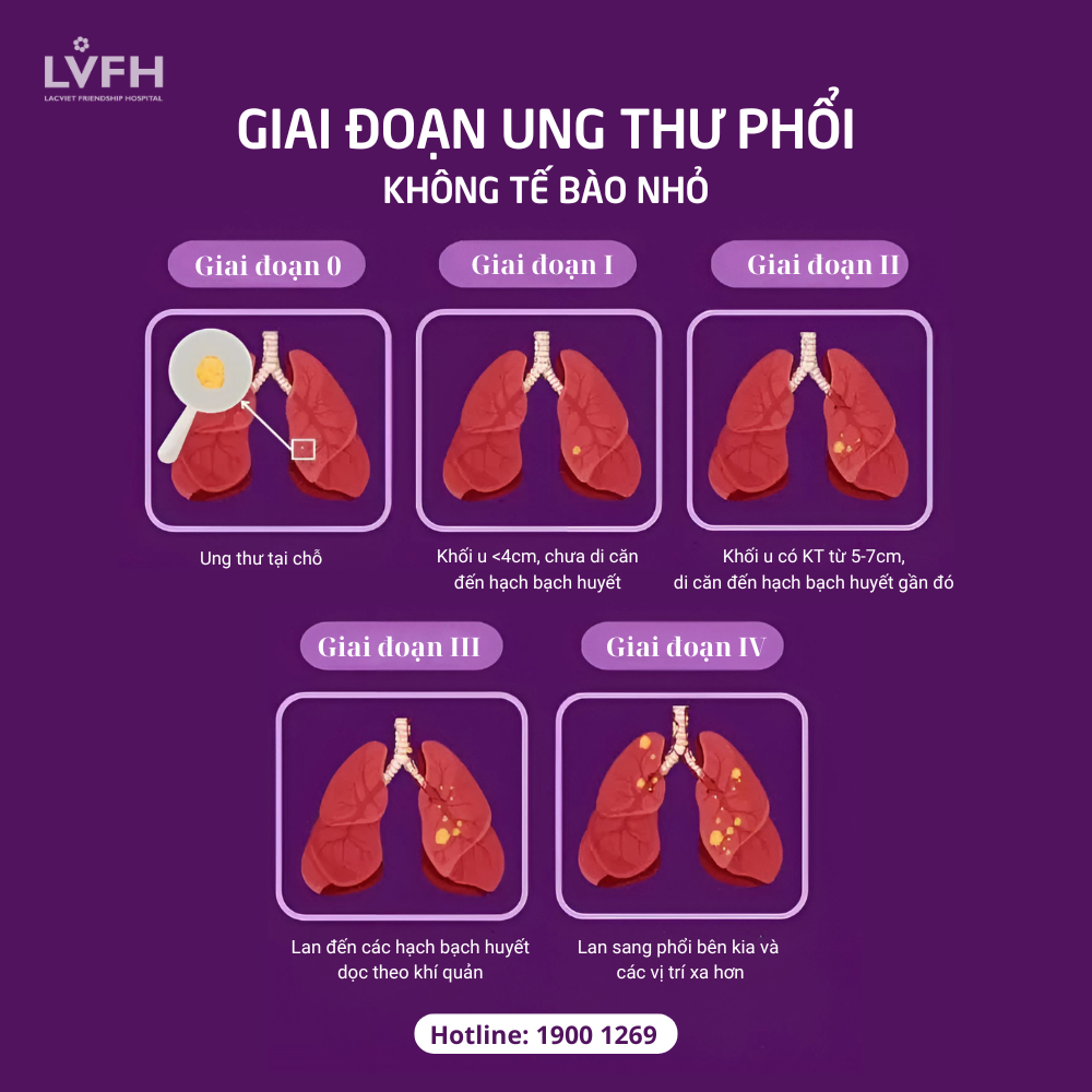 5 giai đoạn của Ung thư phổi không tế bào nhỏ