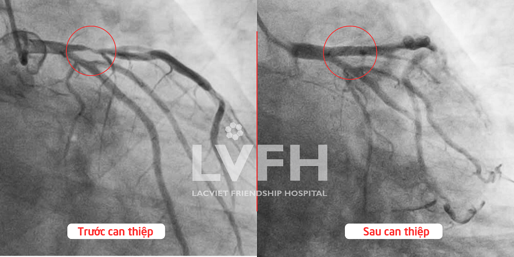 Hình ảnh trước và sau can thiệp mạch của bệnh nhân L.