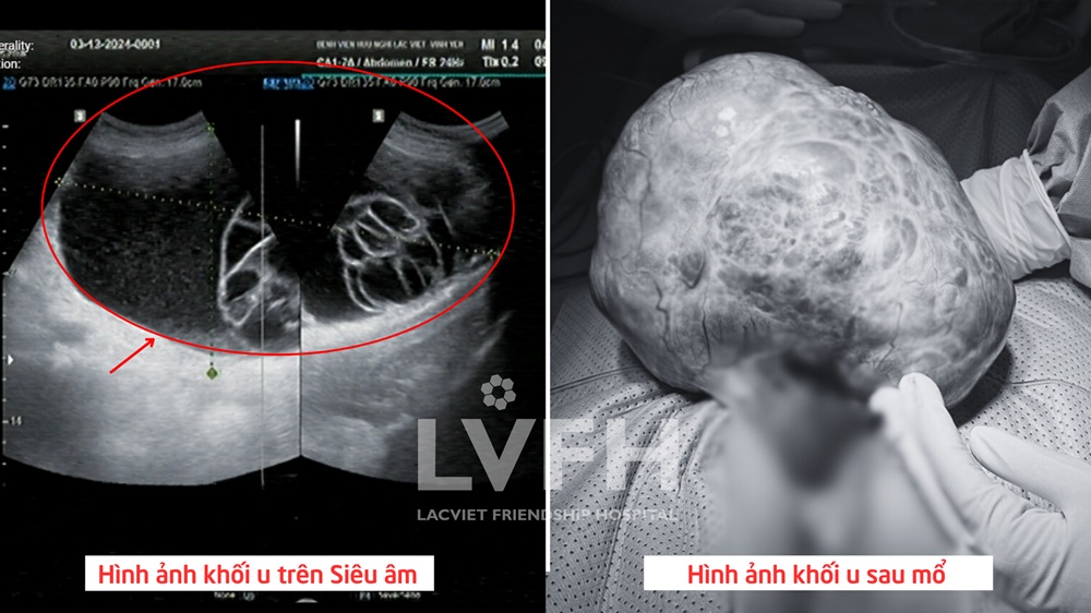 Hình ảnh khối u buồng trứng khổng lồ, đường kính 25cm trên siêu âm và sau mổ