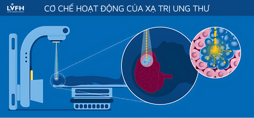 Cơ chế hoạt động của xạ trị ung thư ngoài.