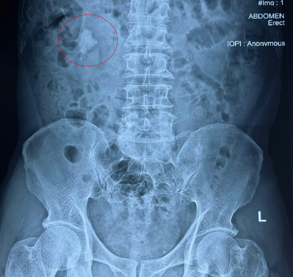 Hình ảnh sỏi san hô của Bệnh nhân T trước khi tán