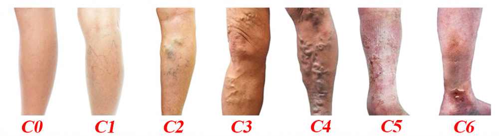 7 cấp độ suy tĩnh mạch được phân chia theo hệ thống CEAP.