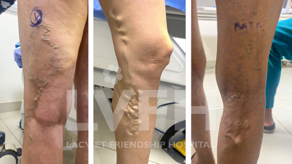 Hình ảnh bệnh nhân suy tĩnh mạch chi dưới