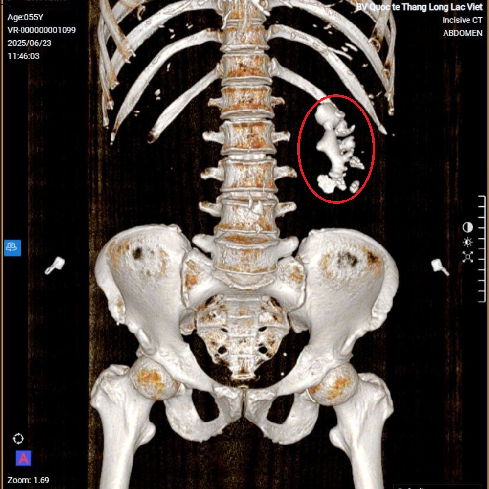 Hình ảnh chụp CT cho thấy bệnh nhân có sỏi thận “to như củ gừng".