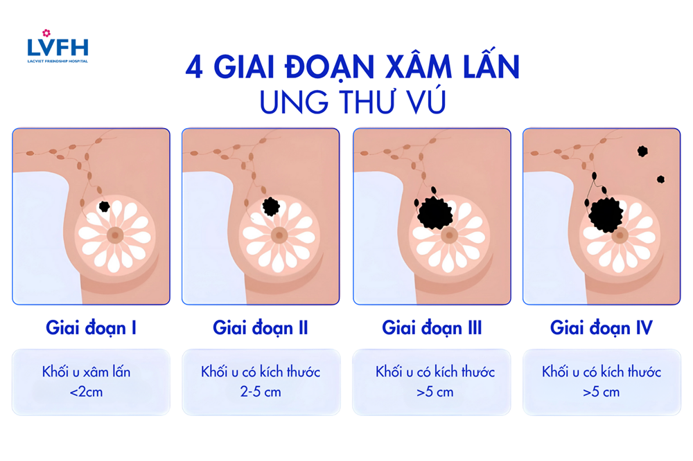 4 giai đoạn xâm lấn ung thư vú