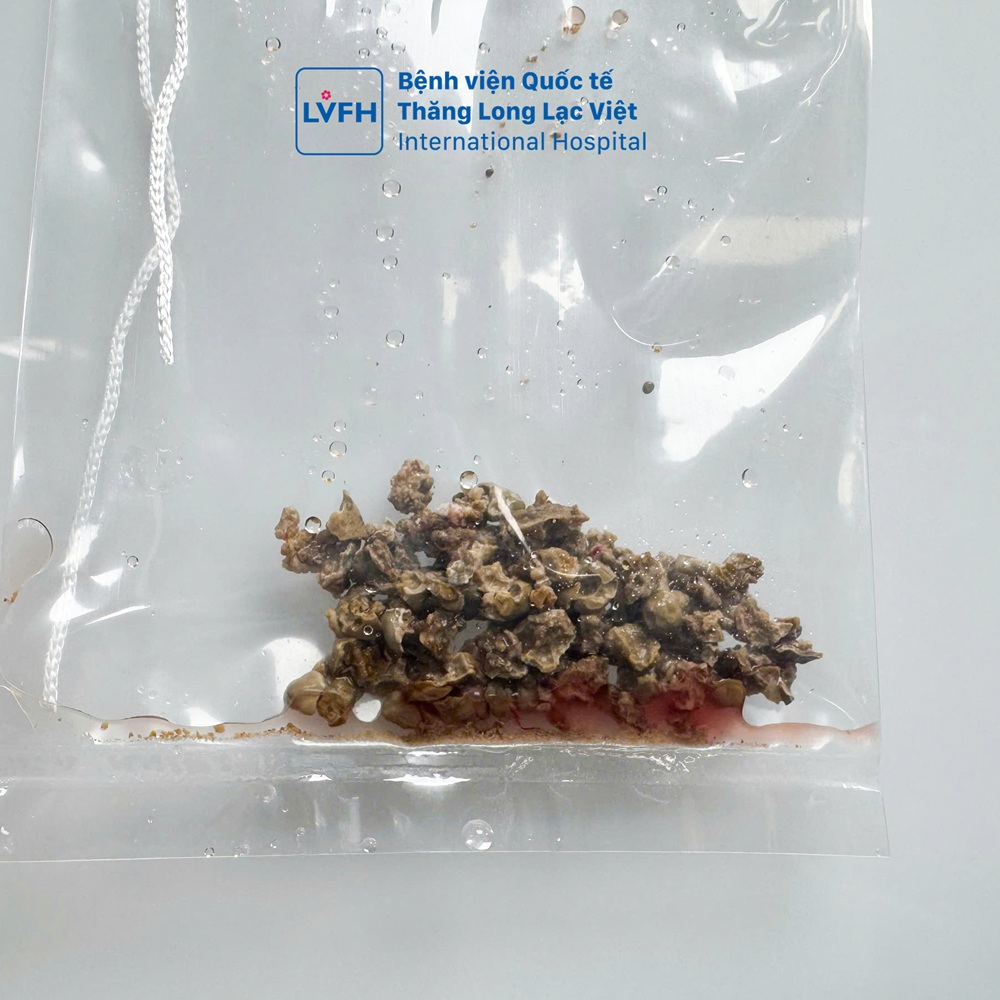 Sau tán, viên sỏi có kích thước lớn “hình củ gừng” của chú H. đã được loại bỏ hoàn toàn.