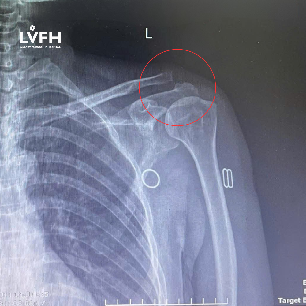 Hình ảnh X-quang trước mổ trật khớp cùng đòn của bệnh nhân.