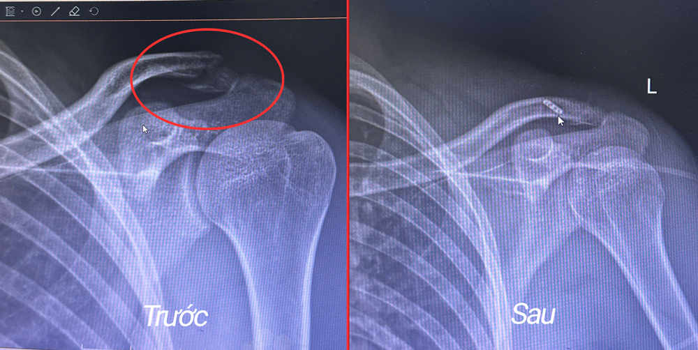 Hình ảnh X-quang trước và sau phẫu thuật nội soi kết hợp xương đòn của bệnh nhân V.