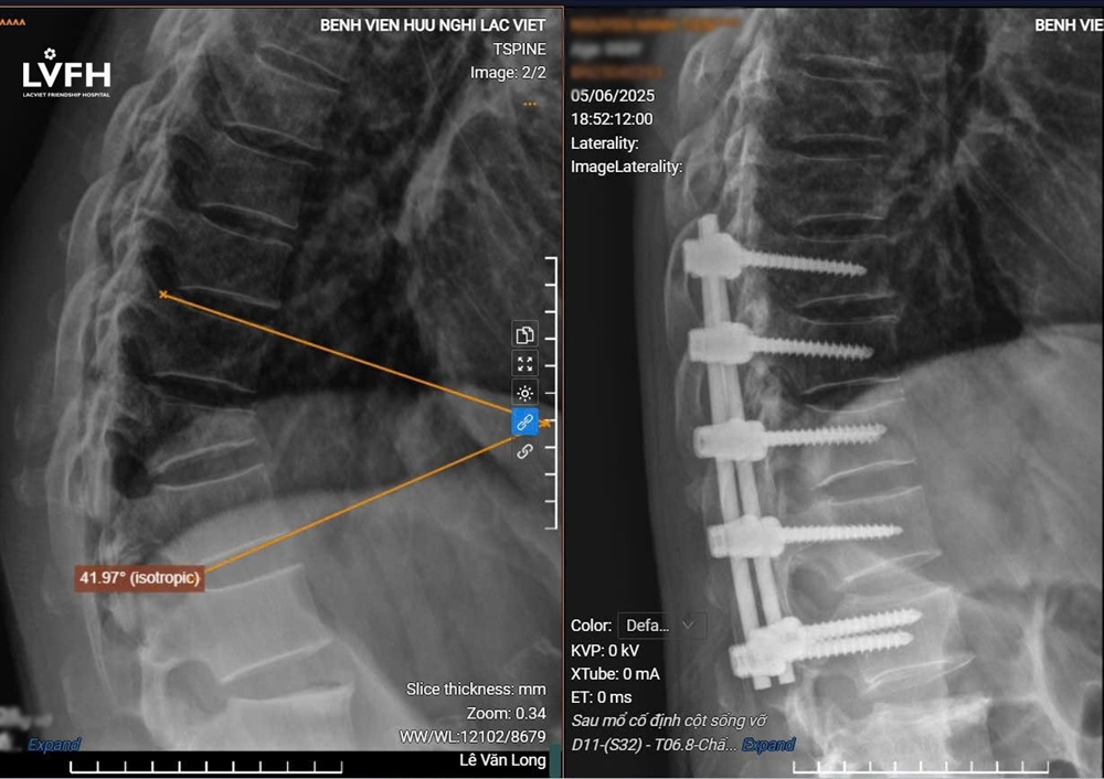 Hình ảnh X-Quang cột sống của bệnh nhân T. trước và sau phẫu thuật chỉnh gù cột sống