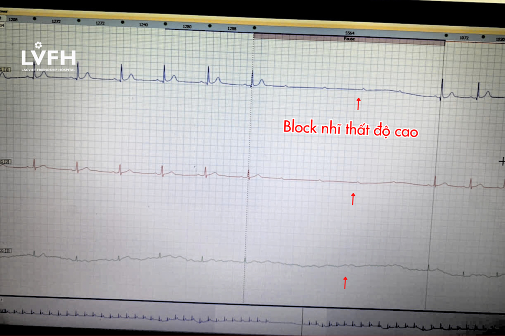 Kết quả đo Holter Điện tâm đồ 24h bắt được 3 cơn rối loạn nhịp nguy hiểm.
